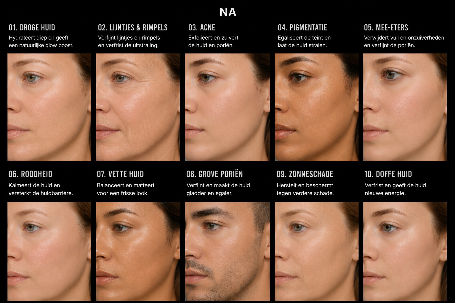 Resultaat na een HydraFacial-behandeling: zichtbare verbetering bij alle tien huidproblemen