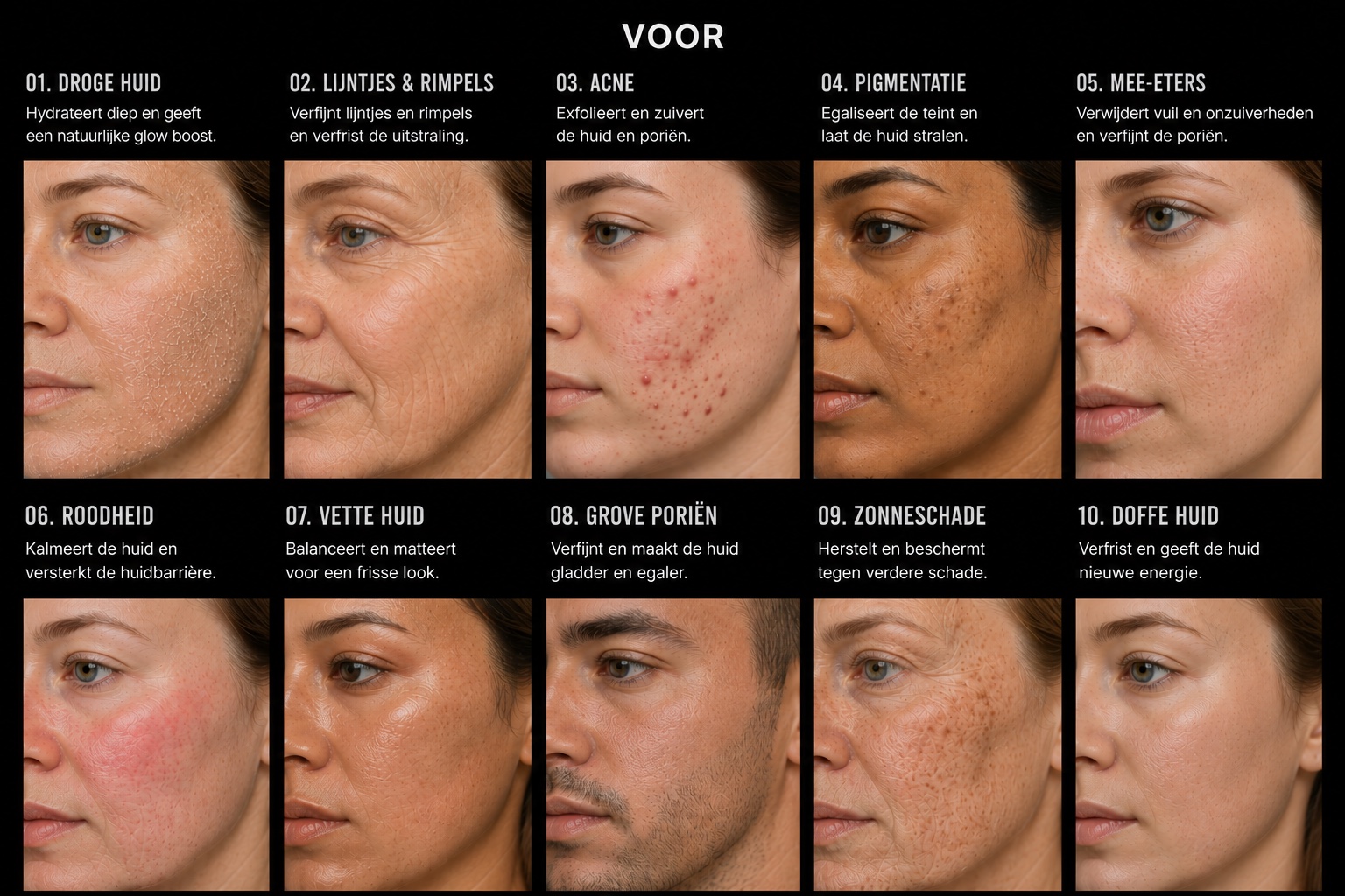 Tien huidproblemen vóór een HydraFacial-behandeling: droge huid, lijntjes, acne, pigmentatie, mee-eters, roodheid, vette huid, grove poriën, zonneschade en doffe huid